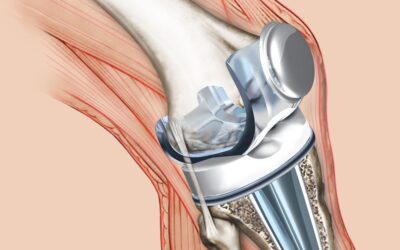 Questions Asked By Patients Considering Knee Replacement Surgery