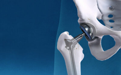 The Future of Minimally Invasive Hip Replacement With Daniel Mascarenhas, MD
