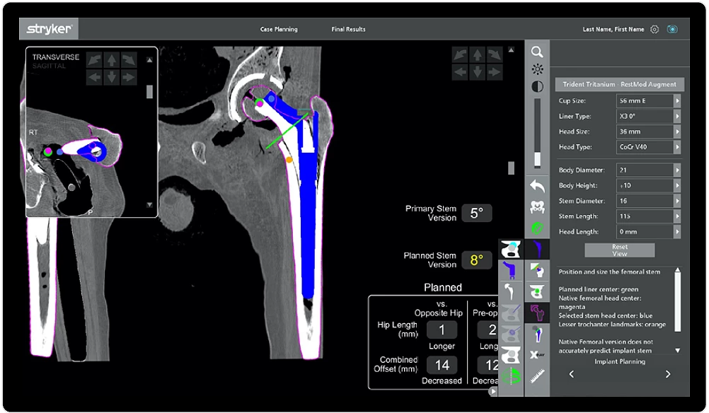 Personalized hip replacement in Boston